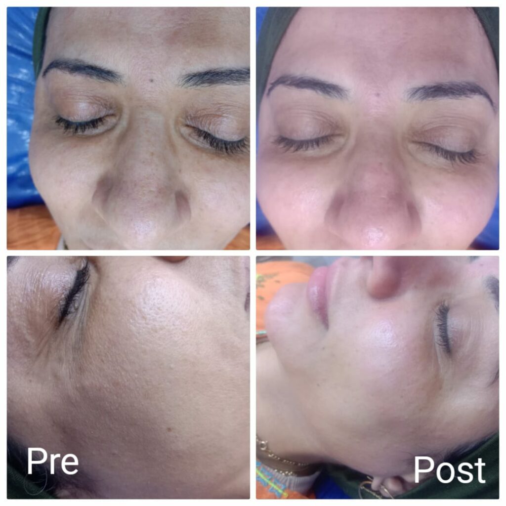 قبل وبعد جلسة تنظيف عميق للبشرة